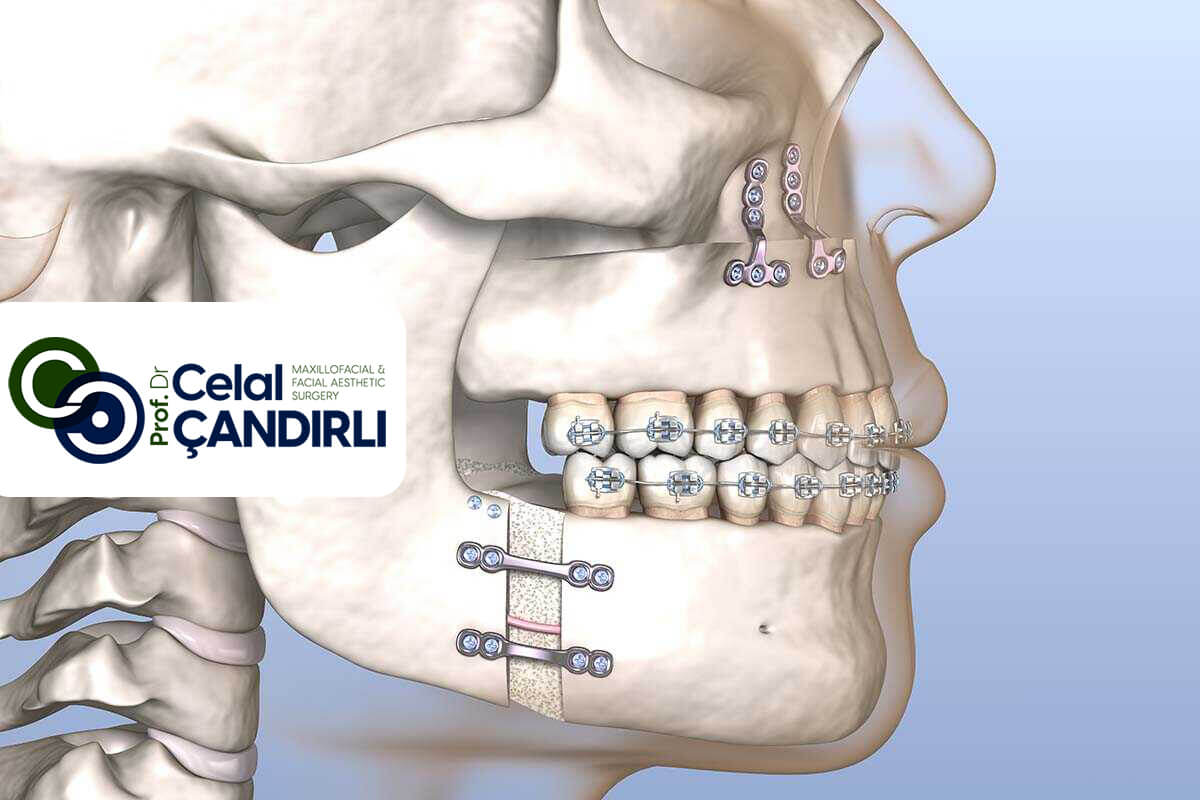 About Orthognathic Surgery