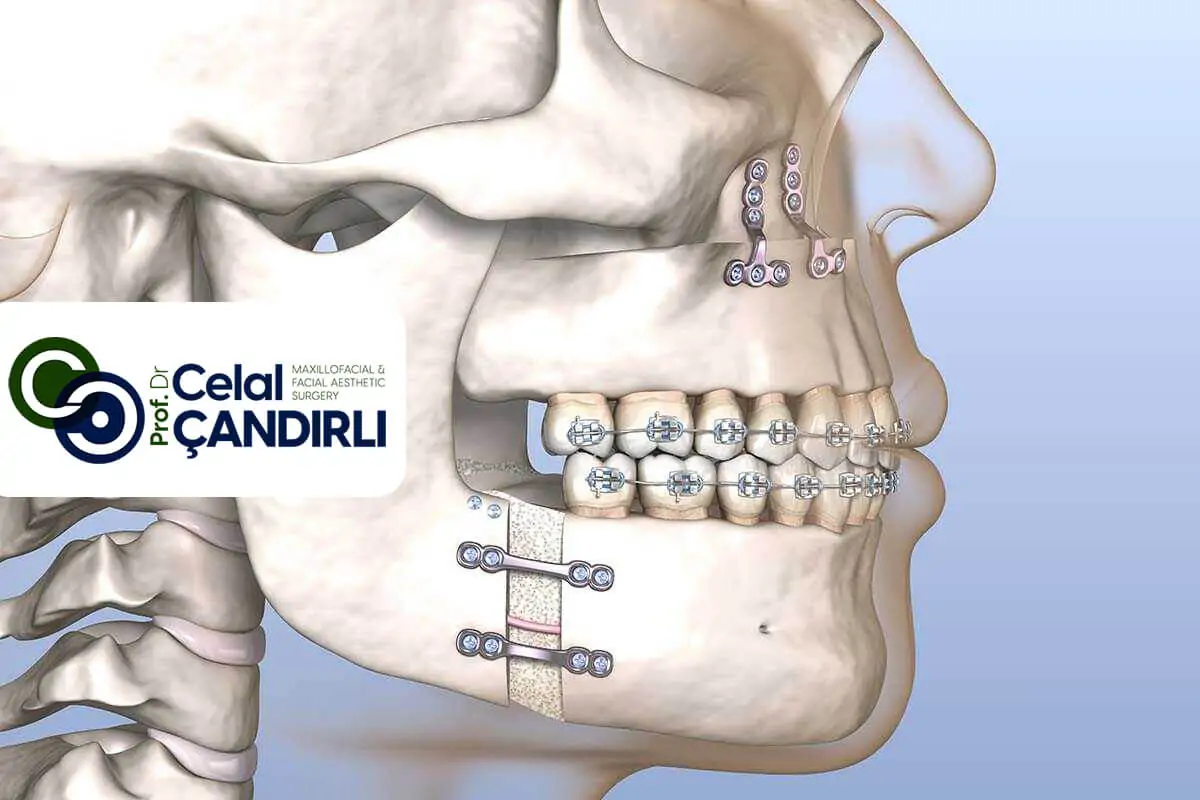 About Orthognathic Surgery