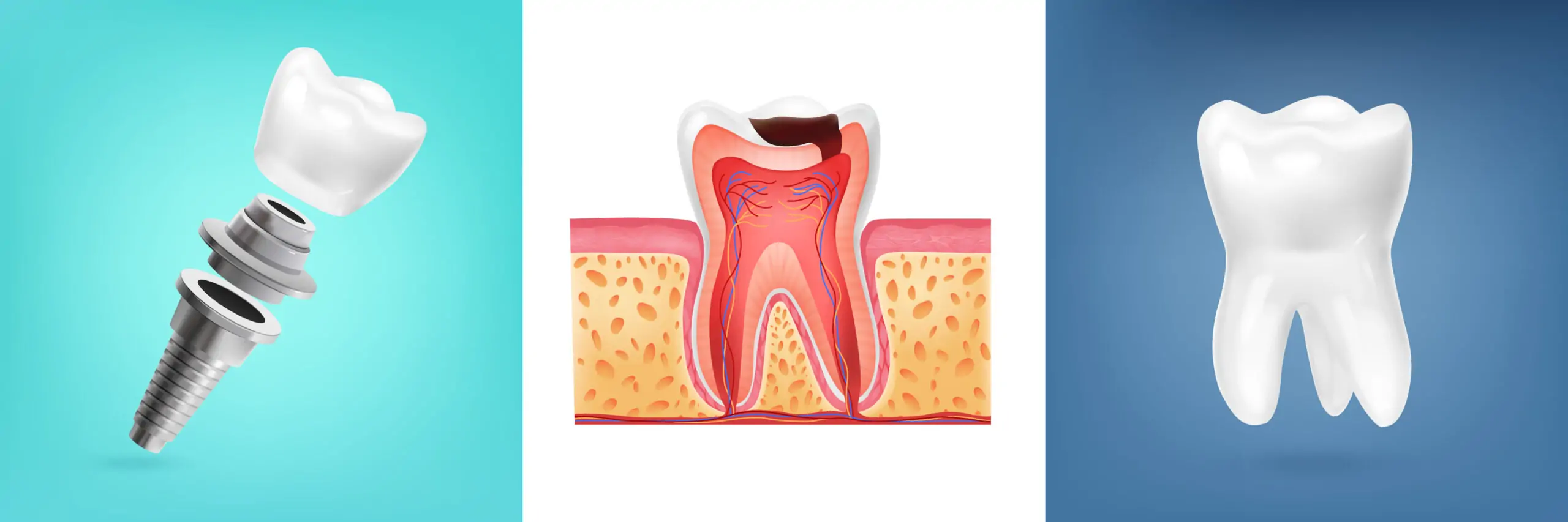 dental-implant-healing-time