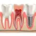 dental-implant-healing-time