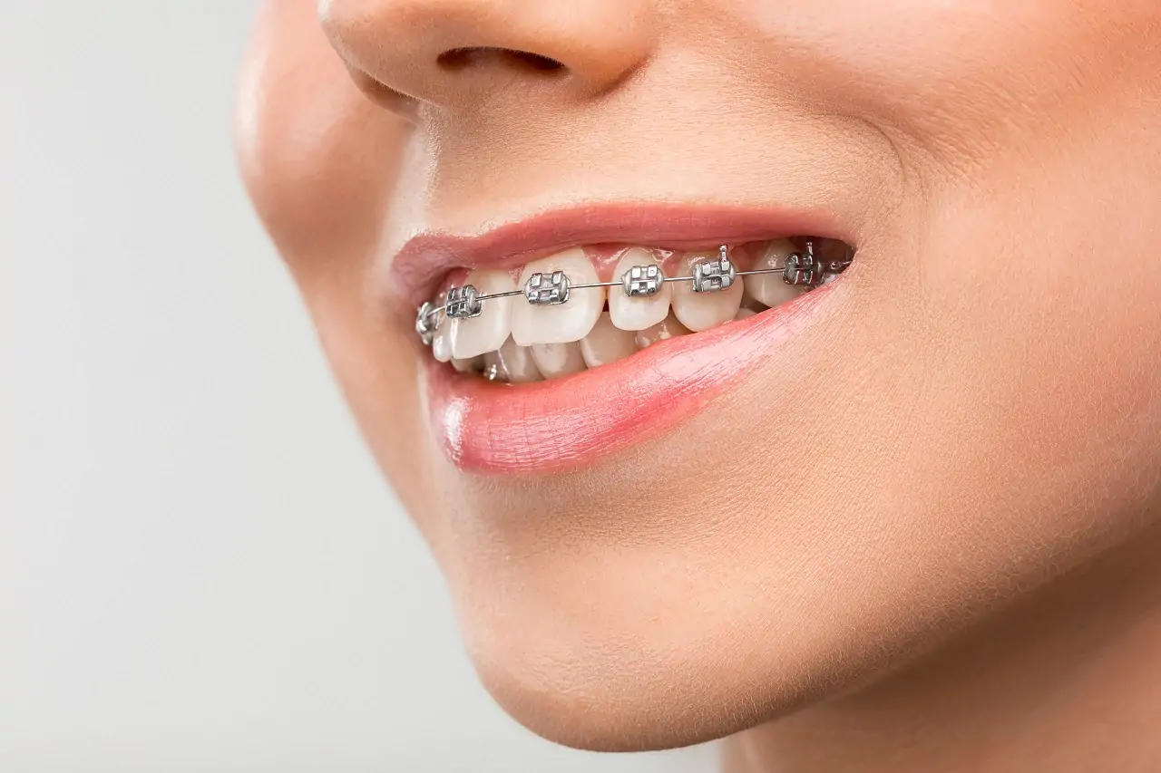 What are the Orthodontic Treatment Benefits?