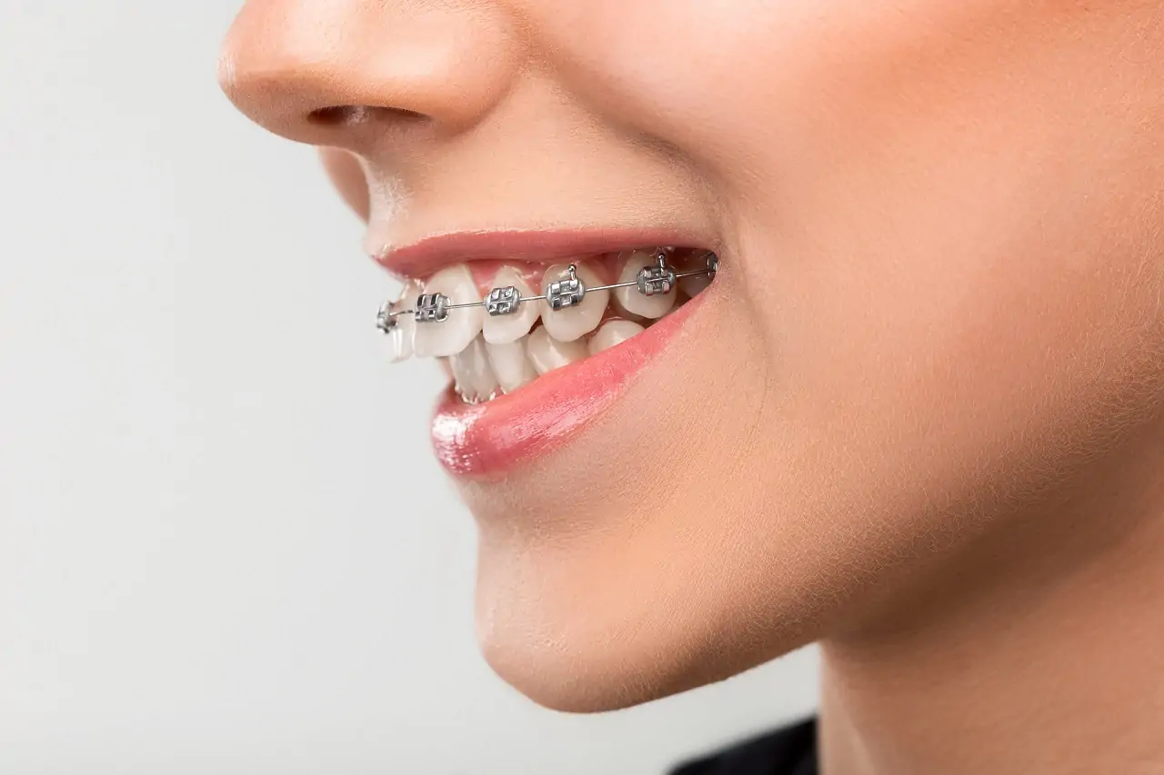 orthodontic-treatment-benefits