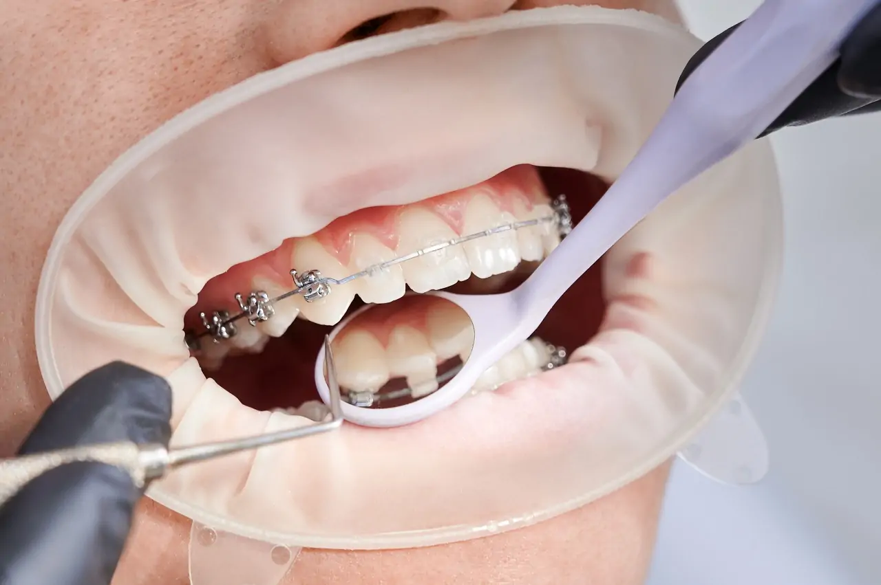 orthodontic-treatment-benefits