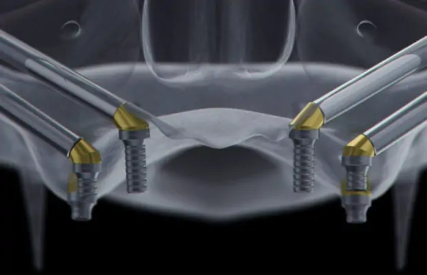 What is Zygomatic Implants? How to Do It?