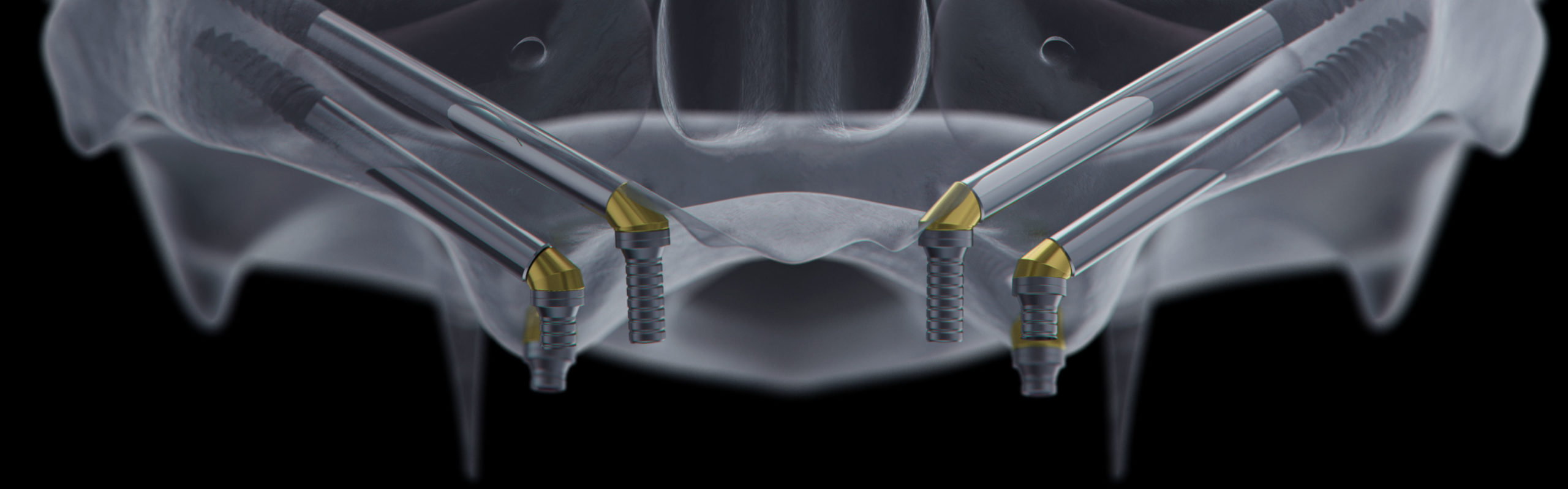 What is Zygomatic Implants? How to Do It?