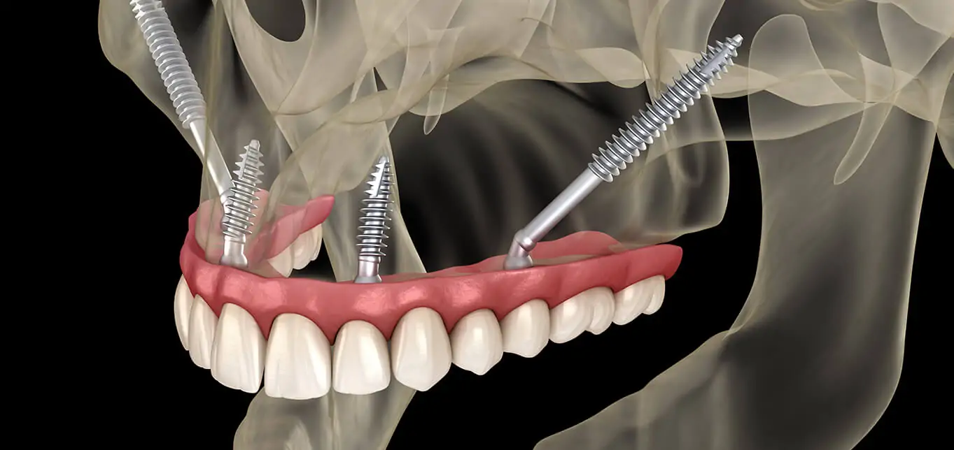 Zygomatic implants