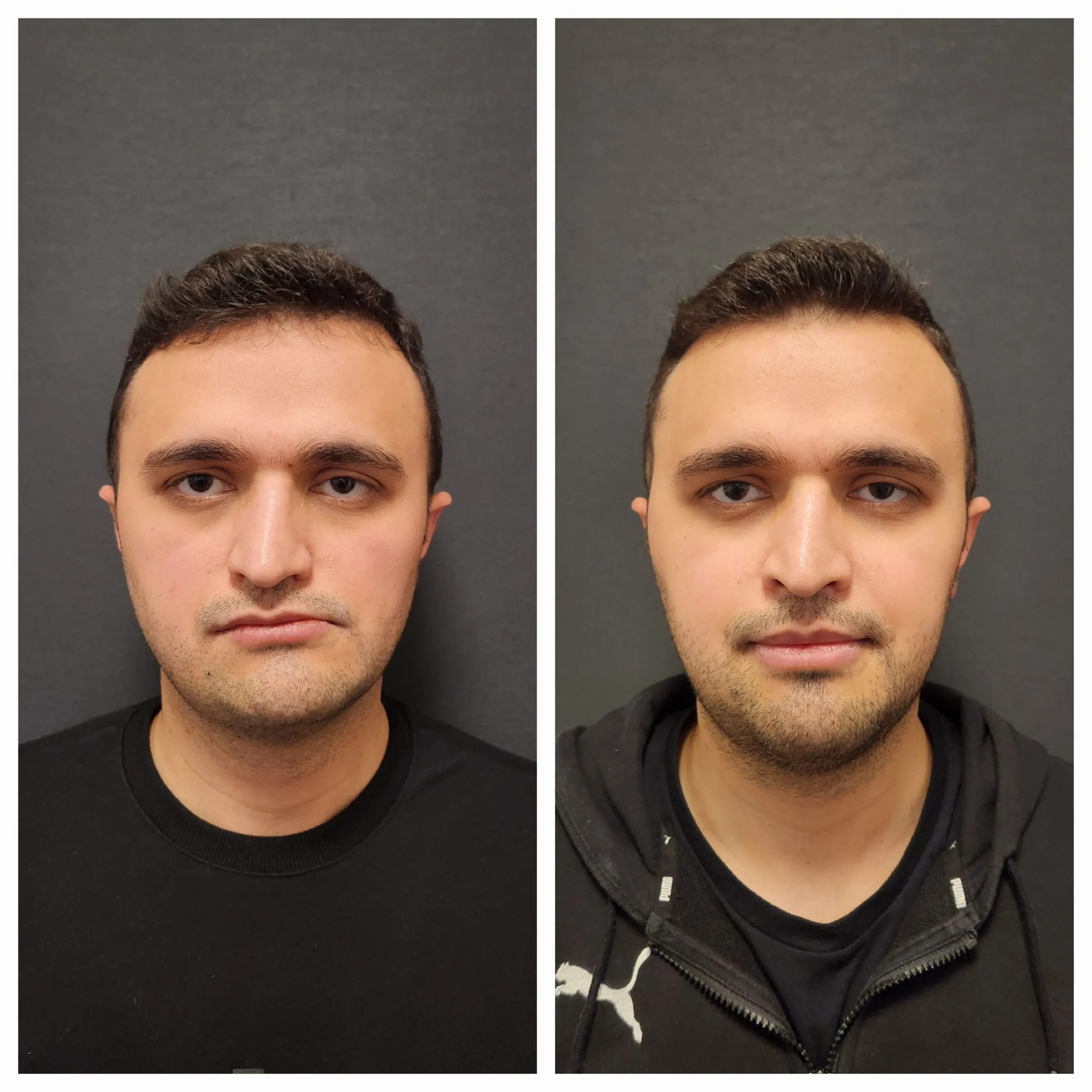 Orthognathic-surgery-before- and-after- jaw-replacement-surgery