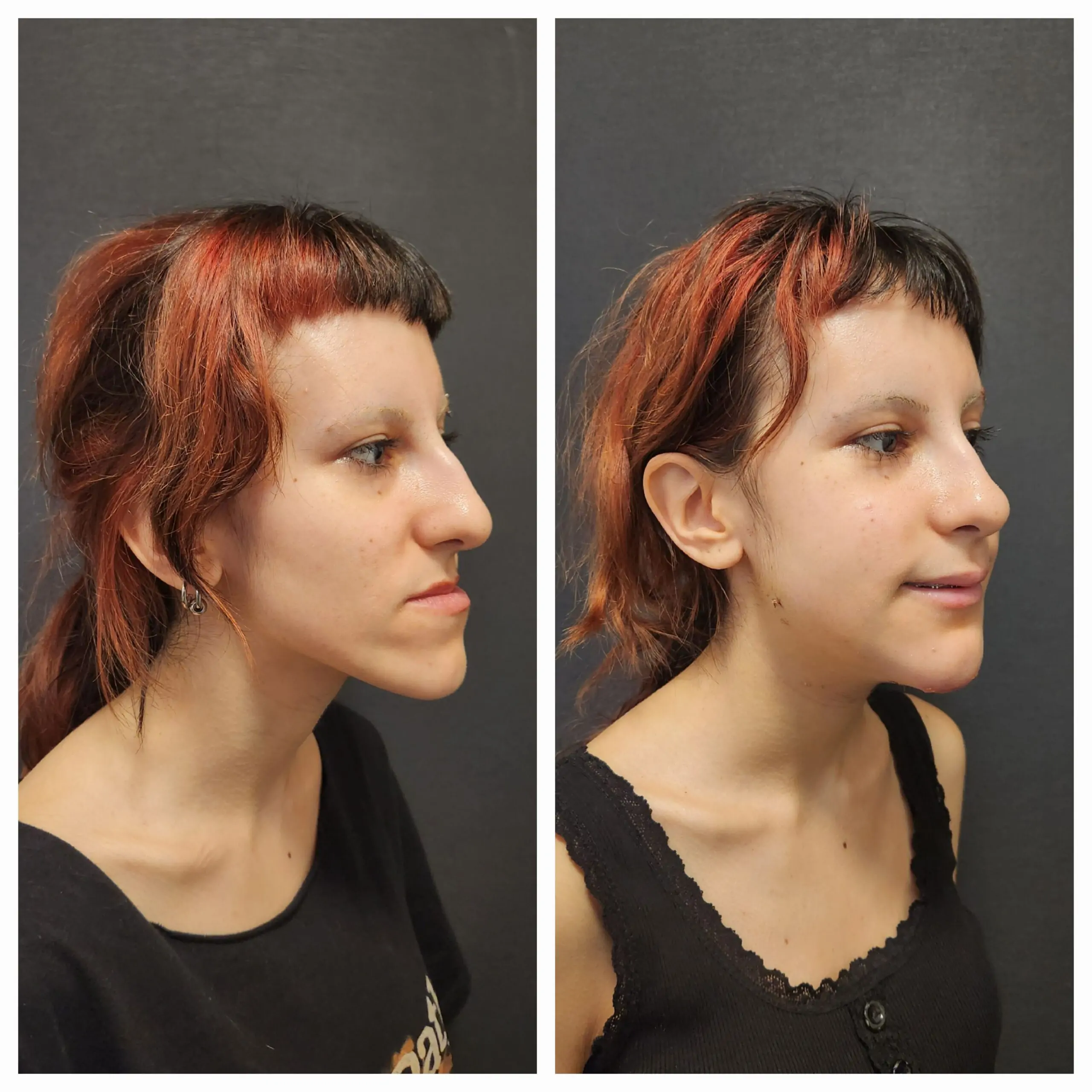 Orthognathic-surgery-before- and-after- jaw-replacement-surgery