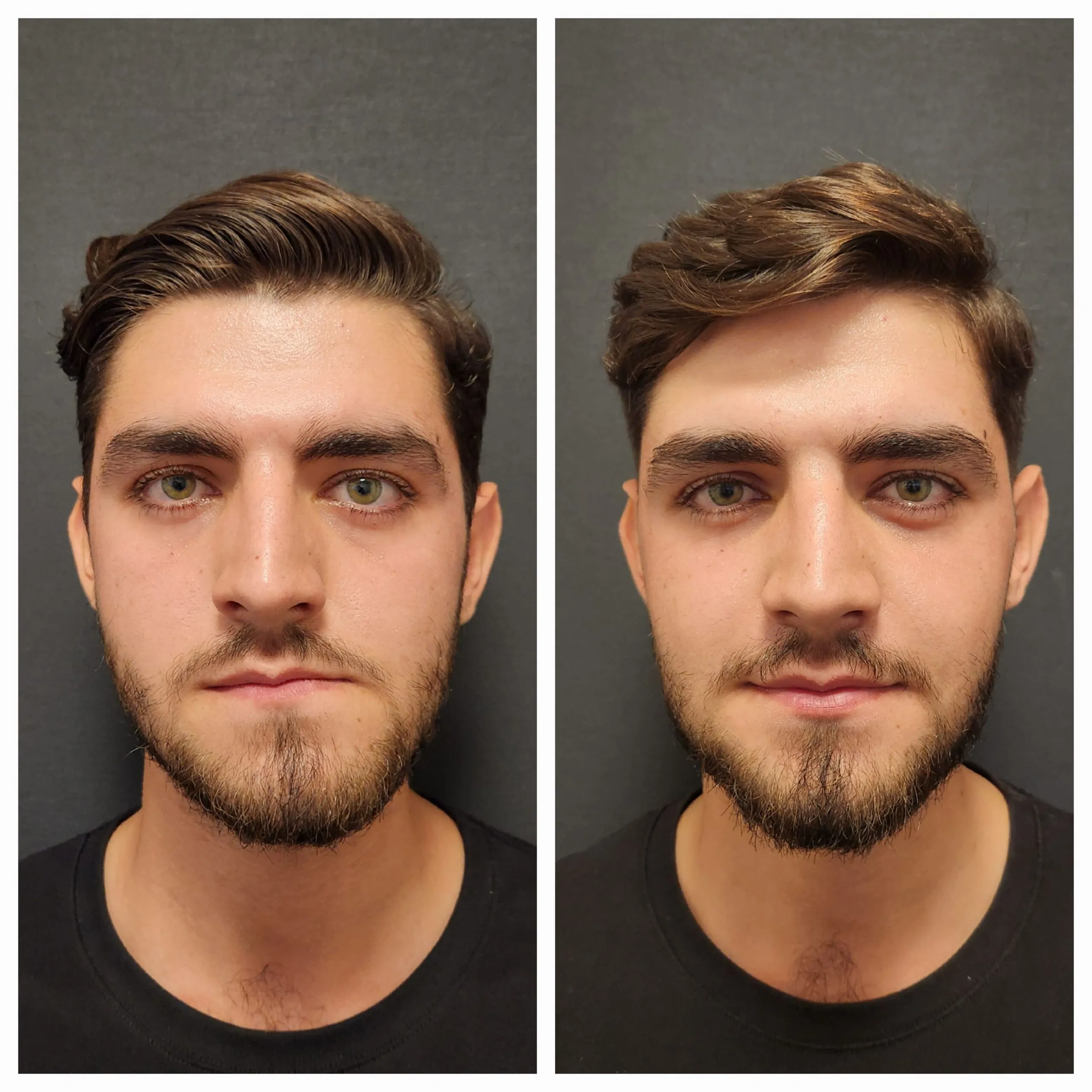 Orthognathic-surgery-before- and-after- jaw-replacement-surgery