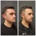 Orthognathic-surgery-before- and-after- jaw-replacement-surgery