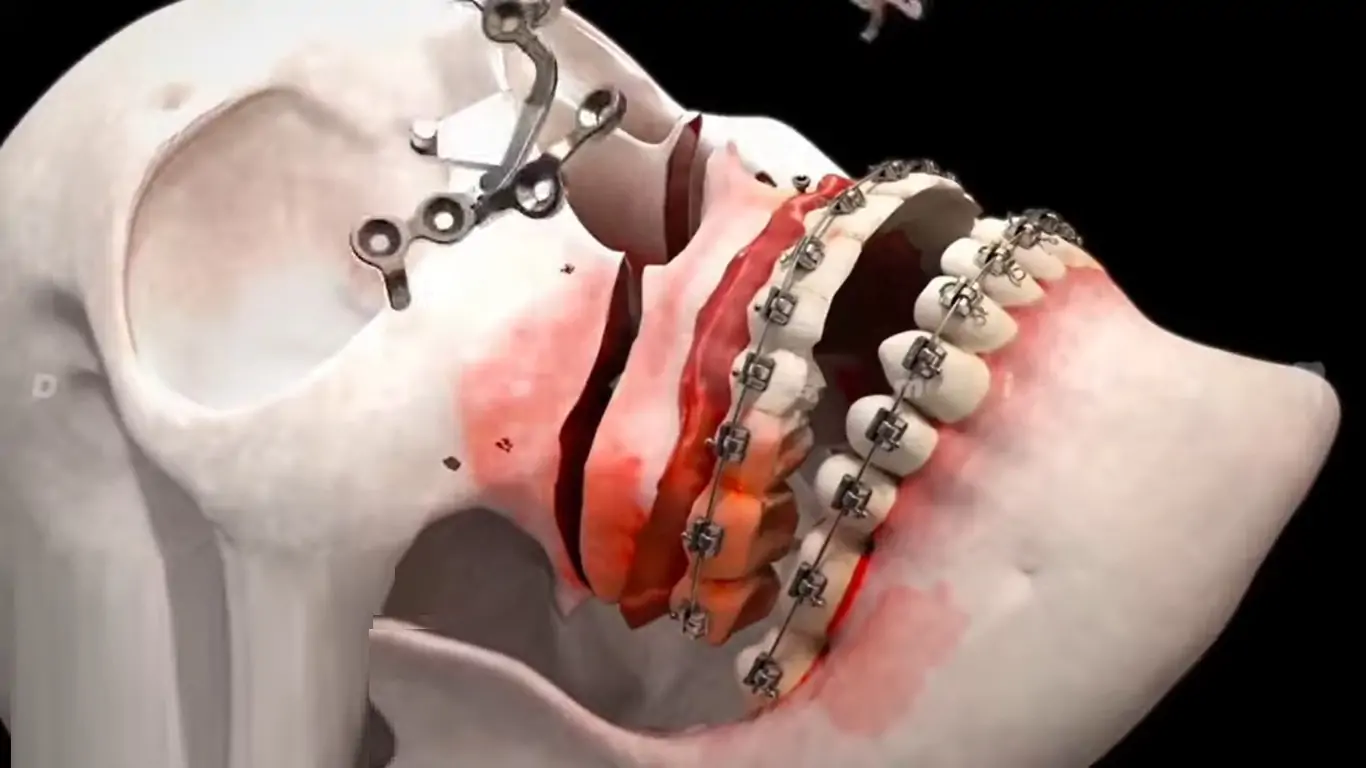 jaw-surgery-orthognathic-2