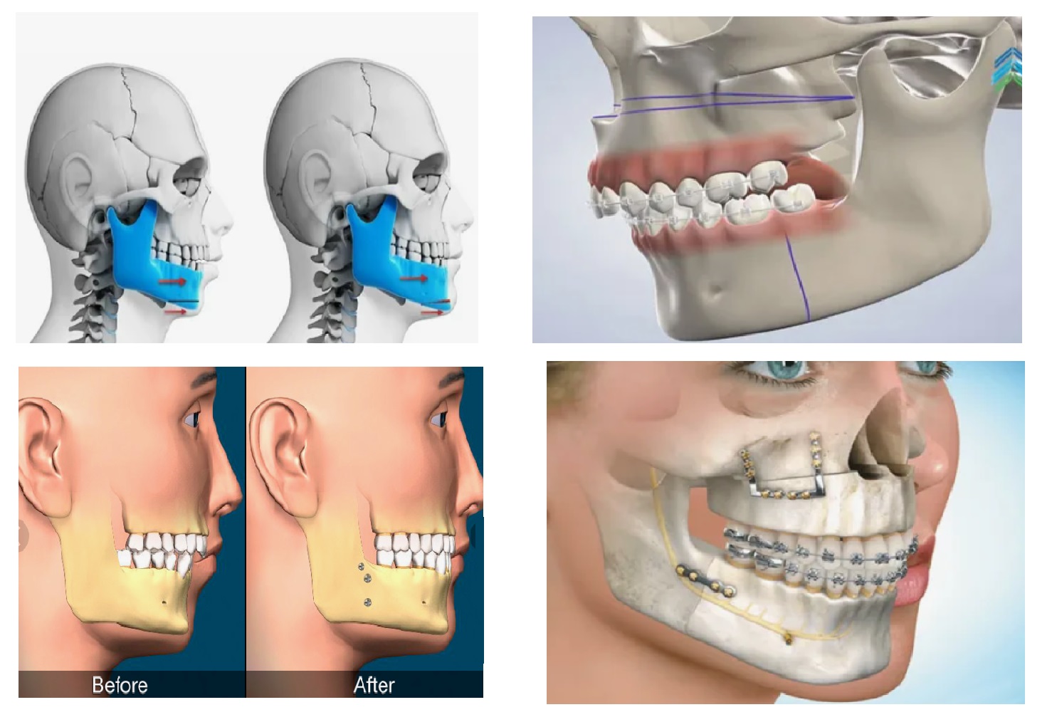 Jaw Surgery Orthognathic Procedures in 5 Steps