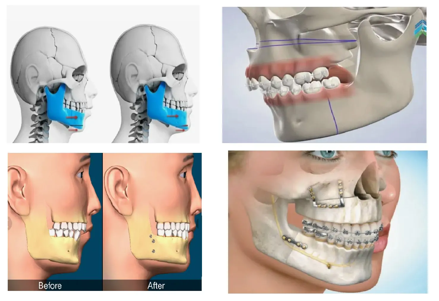 Jaw Surgery Orthognathic Procedures in 5 Steps