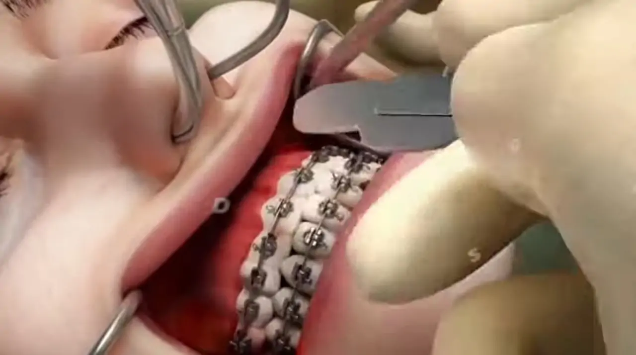 jaw-surgery-orthognathic