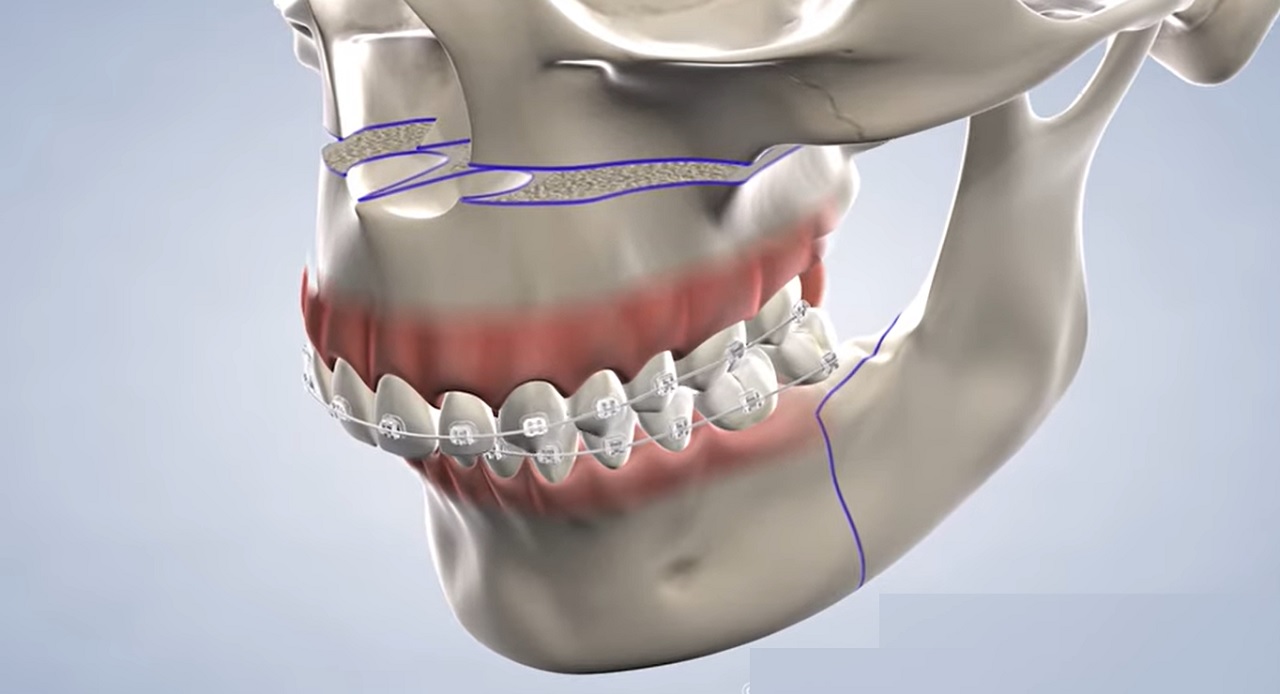 Why is Jaw Surgery Done? Things to Know About Jaw Surgery