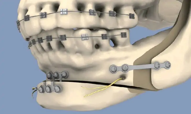 broken-jaw-surgery-2