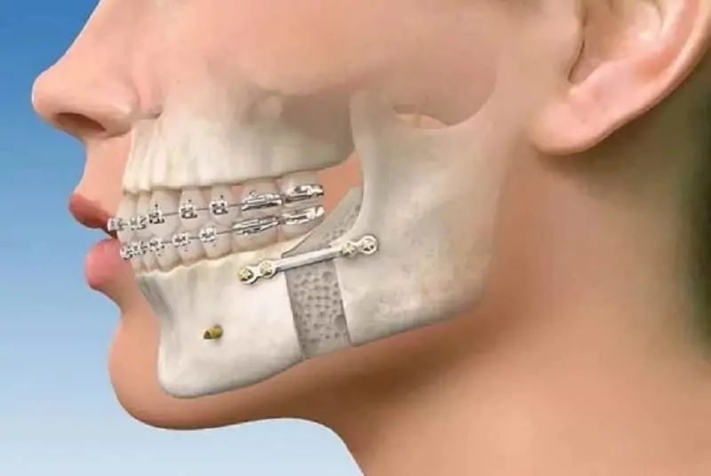 broken-jaw-surgery