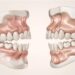 double-corrective-jaw-surgery