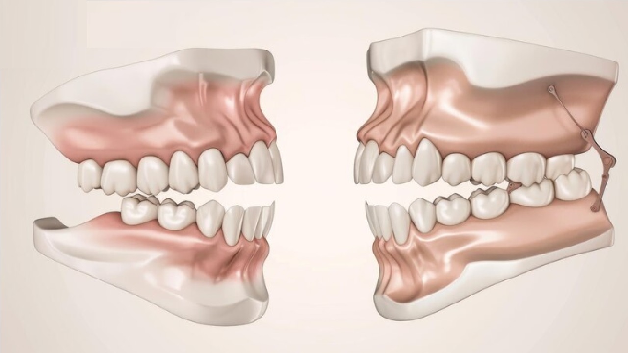 Double Corrective Jaw Surgery: Experience Top-Tier Care at Celal Candirli Clinic