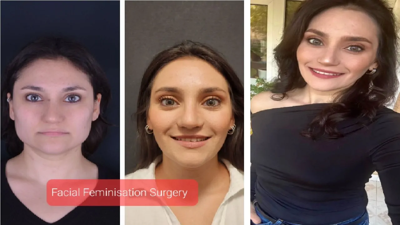 Discover Exceptional Face Feminization Surgery at Celal Candırli Clinic