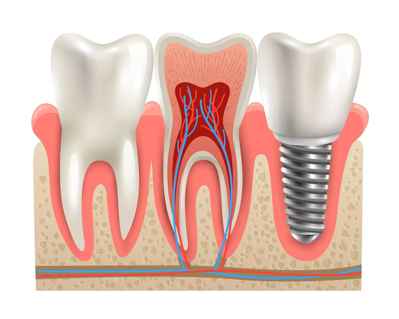 tooth-implant-aftercare