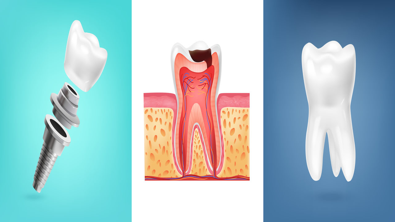 Essential Details for Tooth Implant Aftercare: 7 Key Points for a Successful Recovery