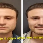 Does double jaw surgery change your face?