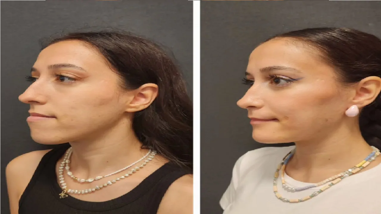 Does double jaw surgery change your face?