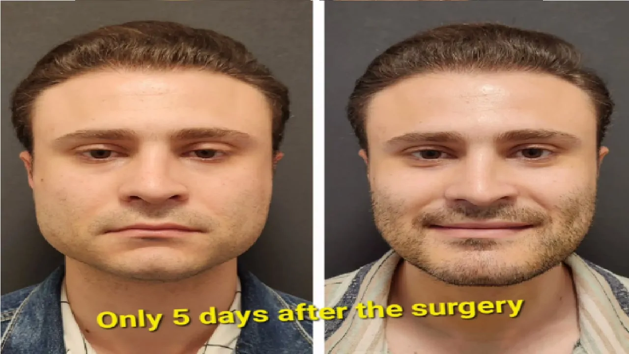 Does double jaw surgery change your face?