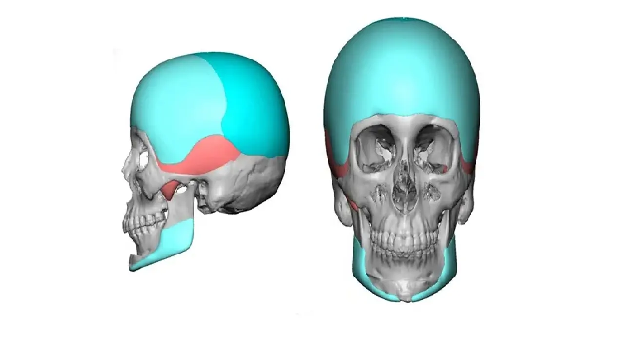 facial-implants-2