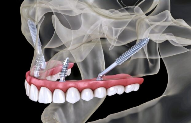 What Are Full Mouth Restoration with Zygoma Implants?