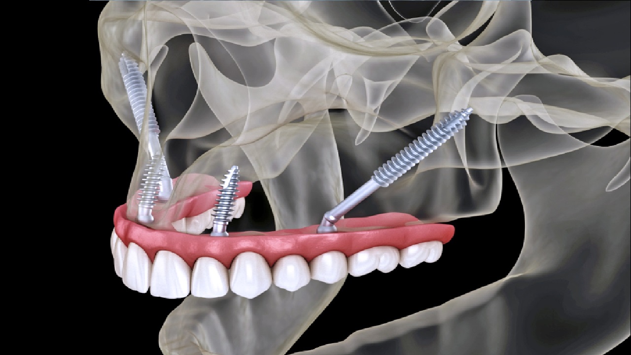 What Are Full Mouth Restoration with Zygoma Implants?