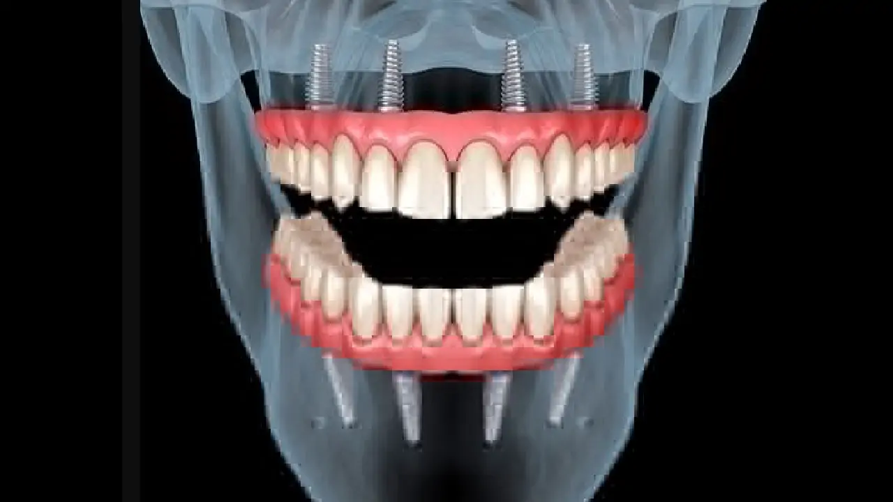 full-mouth-restoration-with-zygoma-implants