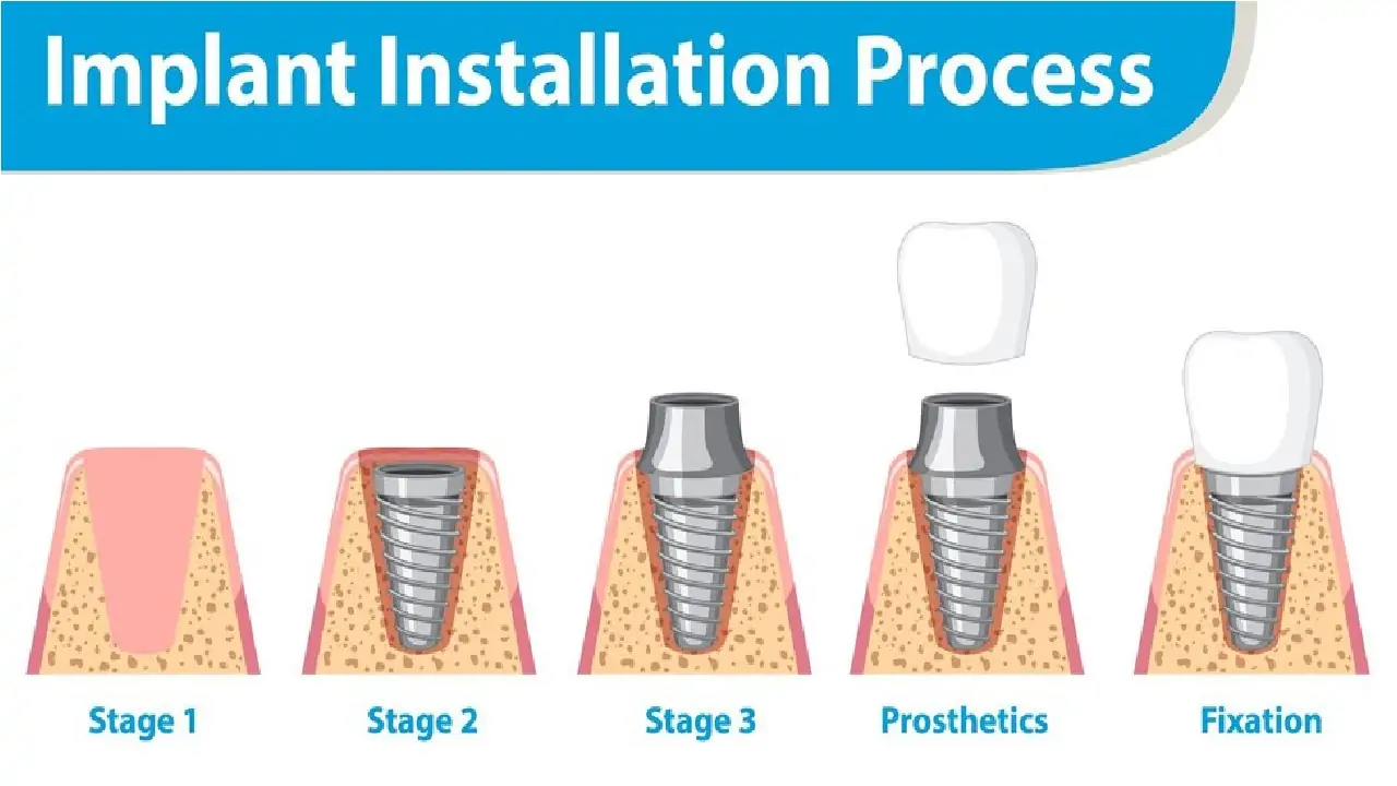 implants-for-severe-bone-loss-3