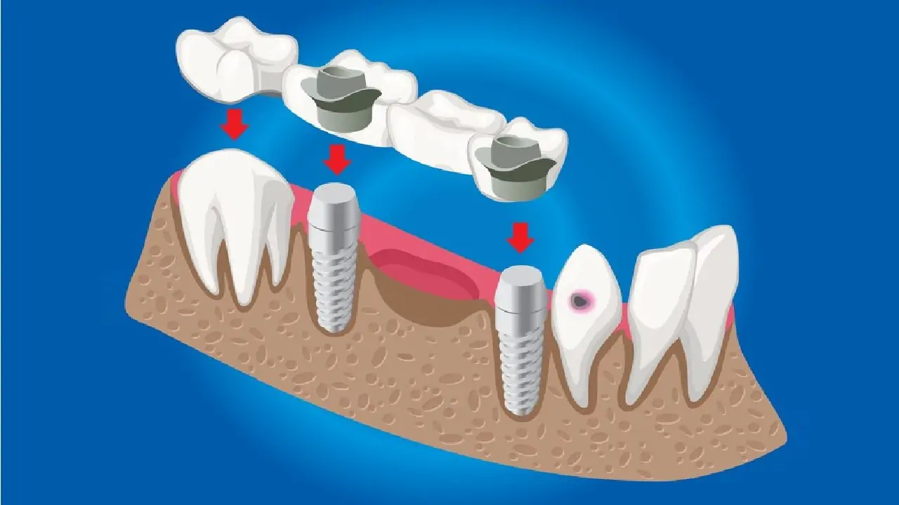 implants-for-severe-bone-loss-4