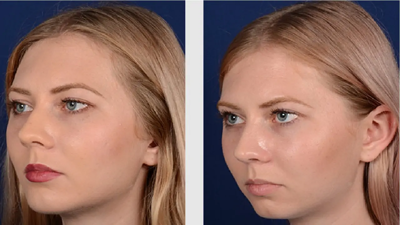 jaw-realignment-surgery