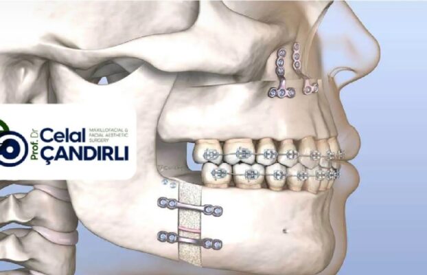 Orthognathic Surgery for TMJ : What You Need to Know