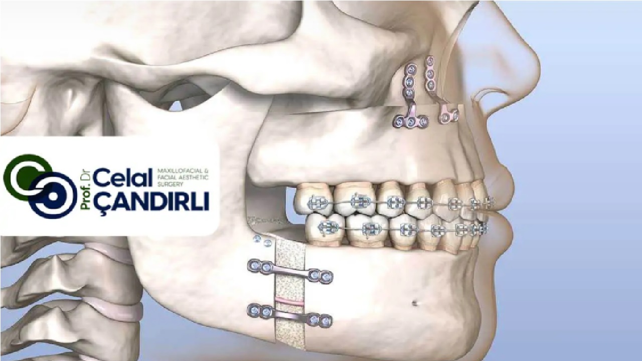 Orthognathic Surgery for TMJ : What You Need to Know