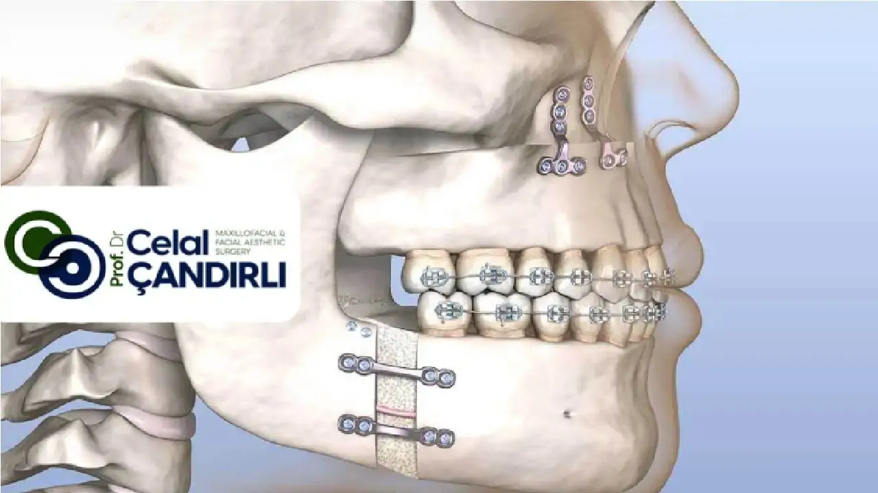 Orthognathic Surgery for TMJ : What You Need to Know