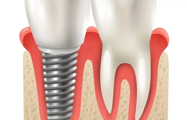 Zigomatik Diş İmplantları – Prof. Dr. Celal Çandırlı