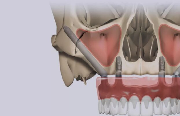 Celal Candirli | Zygoma Implant Specialist