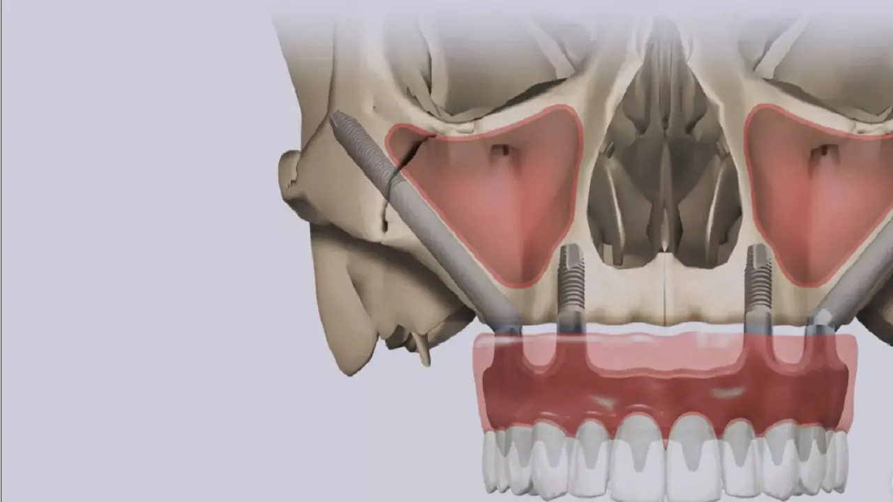 Celal Candirli | Zygoma Implant Specialist