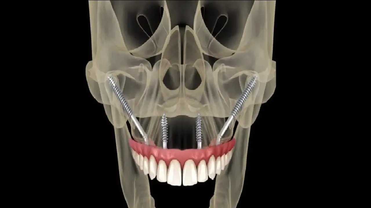 zygoma-implant-specialist-4