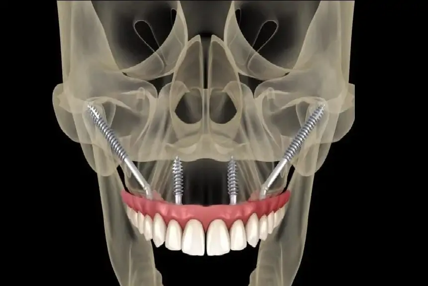 zygoma-implant-specialist