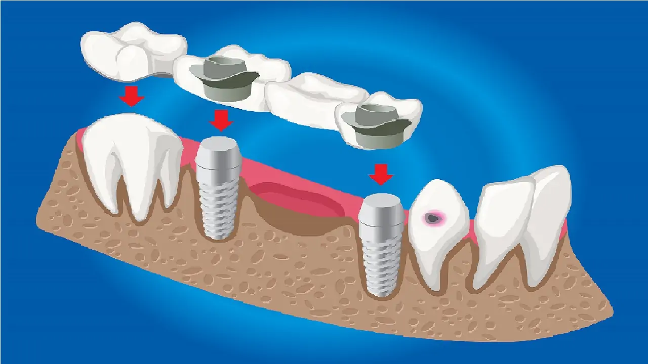 zygomatic-implants