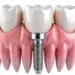 dental-implants-for-severe-bone-resorption-2