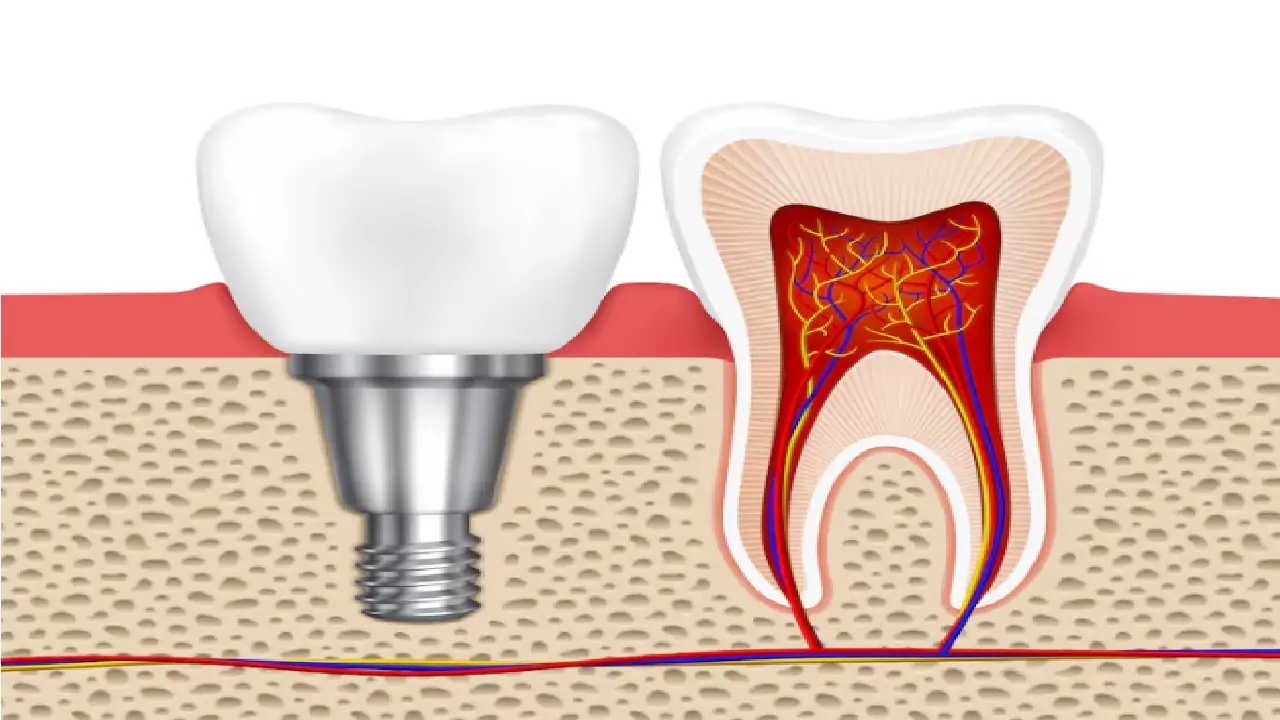 dental-implants-for-severe-bone-resorption-3