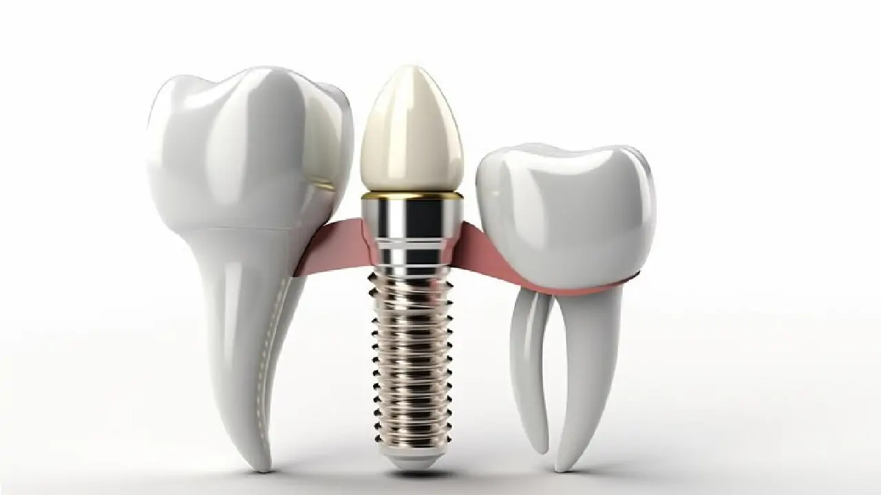 dental-implants-for-severe-bone-resorption-4