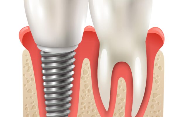 7 Adımda Metal İmplantlarla Yüz Cerrahisi Nasıl Yapılır?