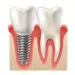 metal-implantlarla-yüz-cerrahisi